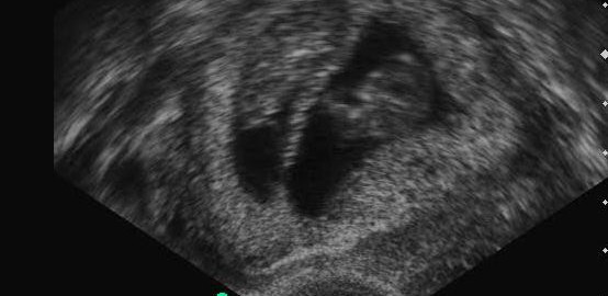 Twins ultrasound 10 weeks
